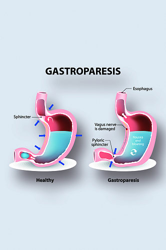 胃轻瘫病症解析图医学器官解剖插图