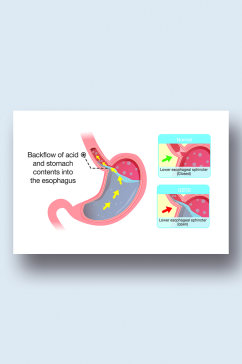 胃酸病症解析图医学器官解剖插图