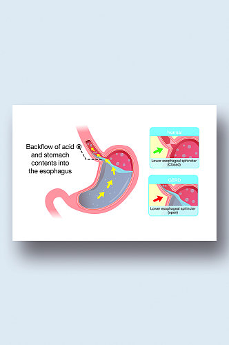 胃酸病症解析图医学器官解剖插图