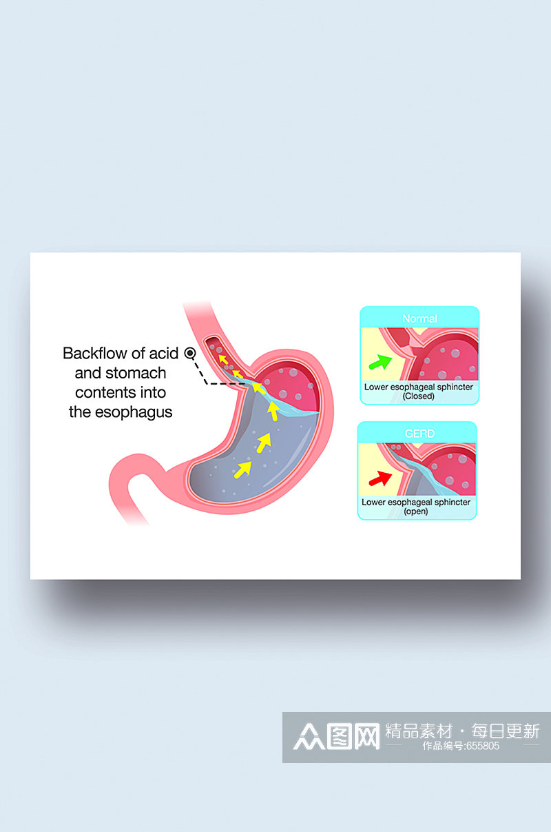 胃酸病症解析图医学器官解剖插图素材