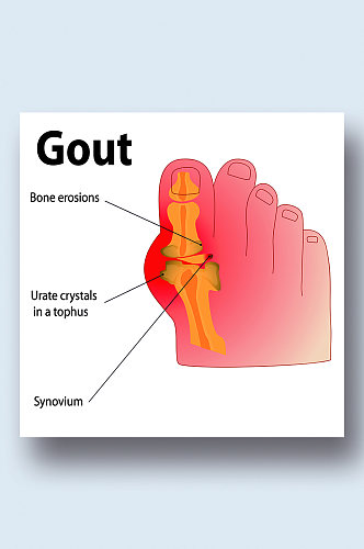 脚痛风病症解析图医学器官解剖插图