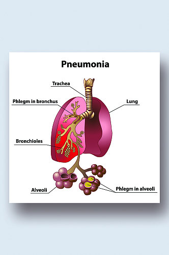 肺炎病症解析图医学器官解剖插图