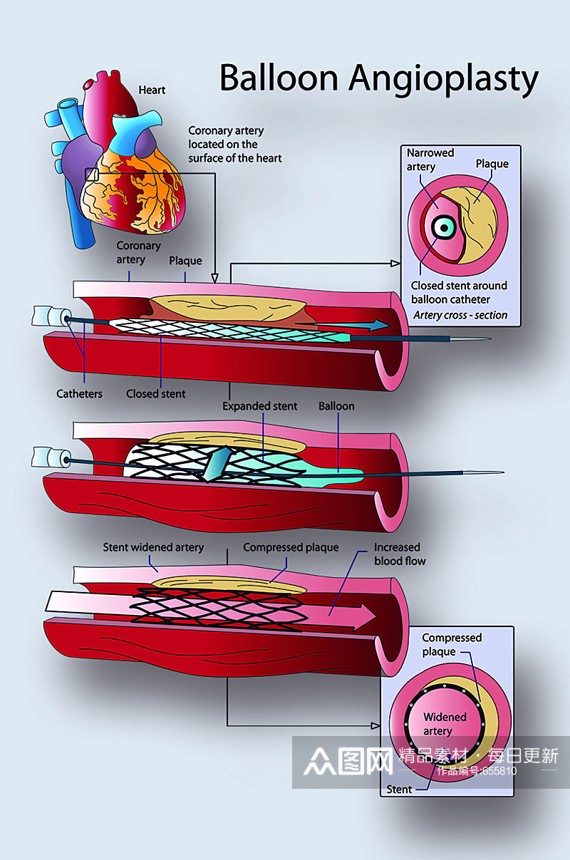 气囊血管成形术病症解析图医学器官解剖插图素材