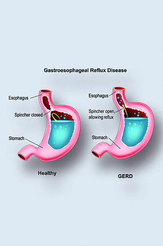胃食管返流病病症解析图医学器官解剖插图