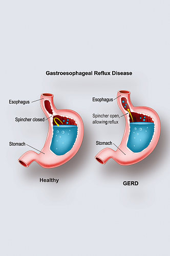 胃食管返流病病症解析图医学器官解剖插图