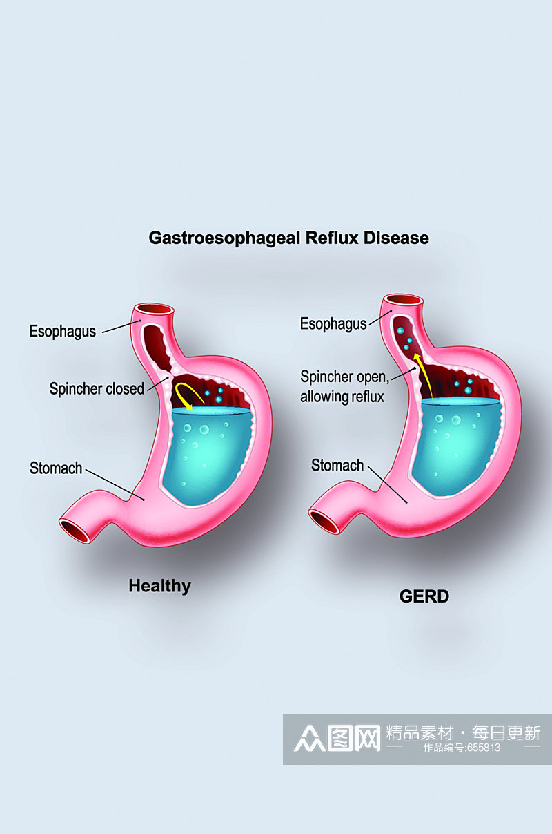 胃食管返流病病症解析图医学器官解剖插图素材