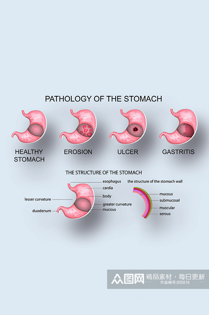 胃病病症解析图医学器官解剖插图素材