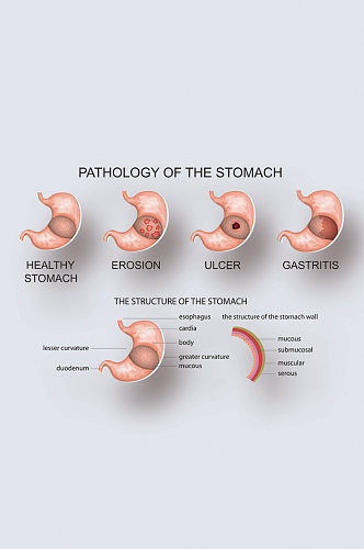 胃病病症解析图医学器官解剖插图