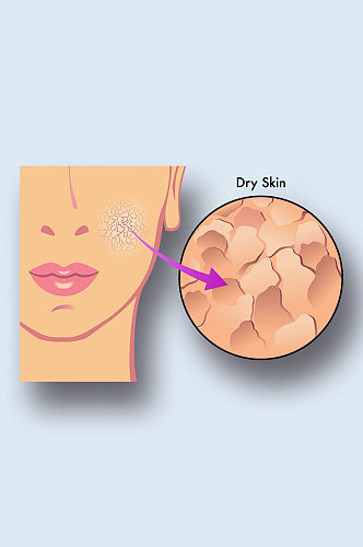 干性皮肤病症解析图医学器官解剖插图