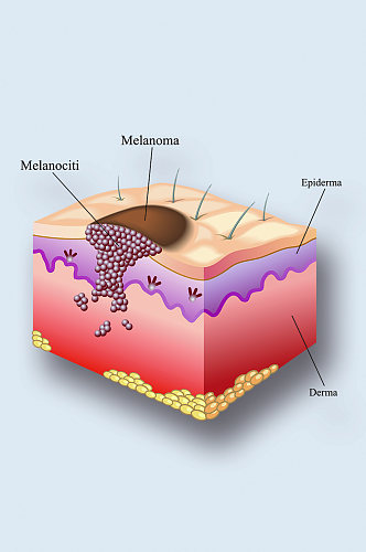 皮肤癌病症解析图医学器官解剖插图