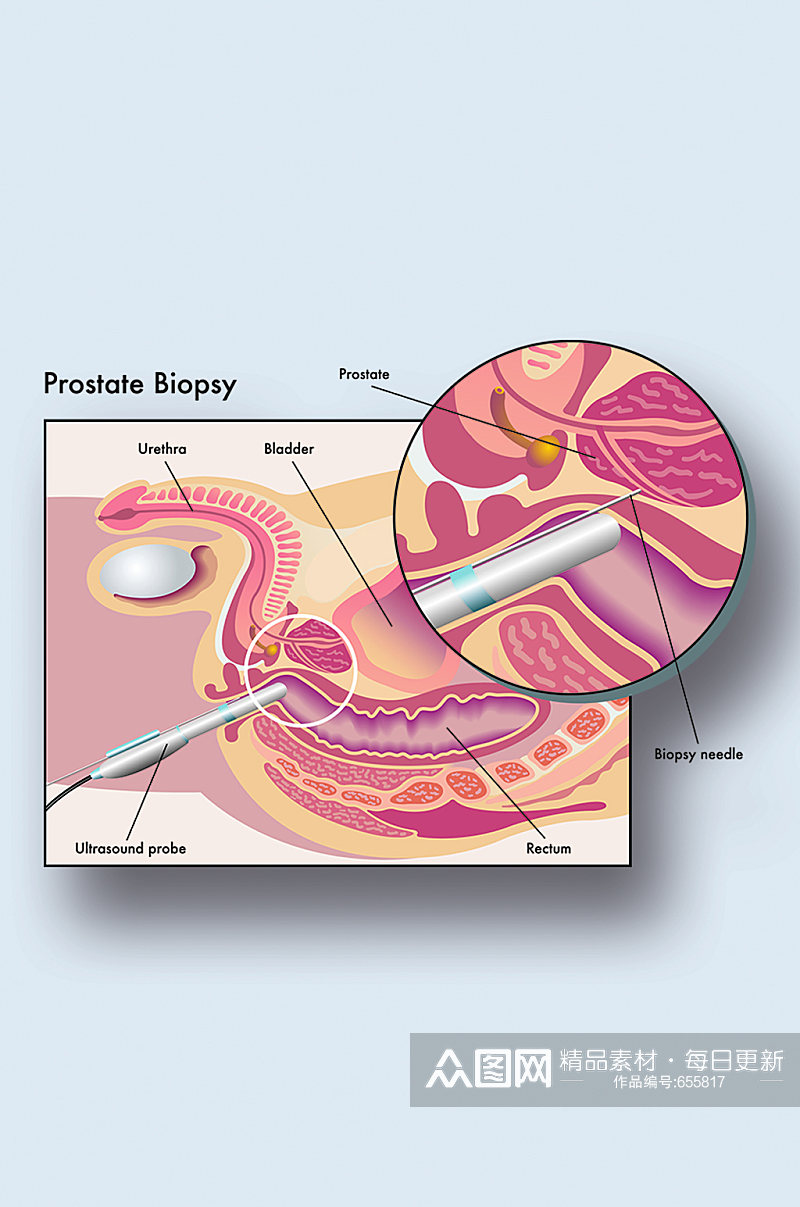 前列腺穿刺病症解析图医学器官解剖插图素材