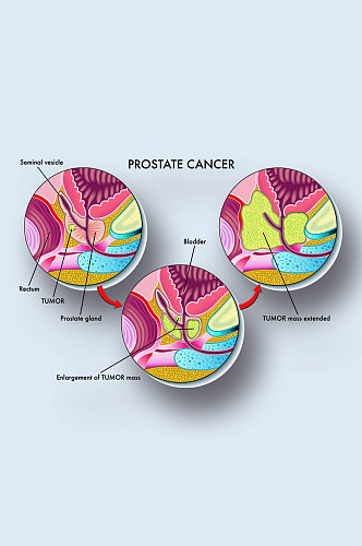 前列腺癌病症解析图医学器官解剖插图