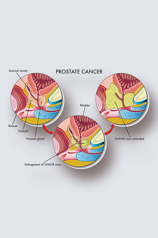 前列腺癌病症解析图医学器官解剖插图-众图网