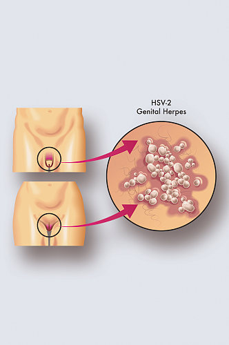 生殖器疱疹病症解析图医学器官解剖插图