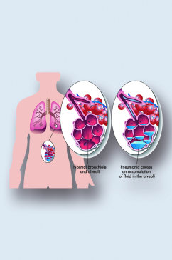 肺病病症解析图医学器官解剖插图