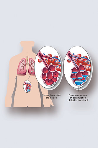 肺病病症解析图医学器官解剖插图