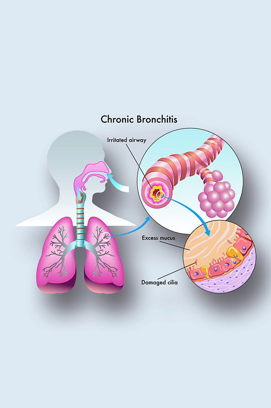 人体慢性支气管炎病症解析图医学器官解剖插图
