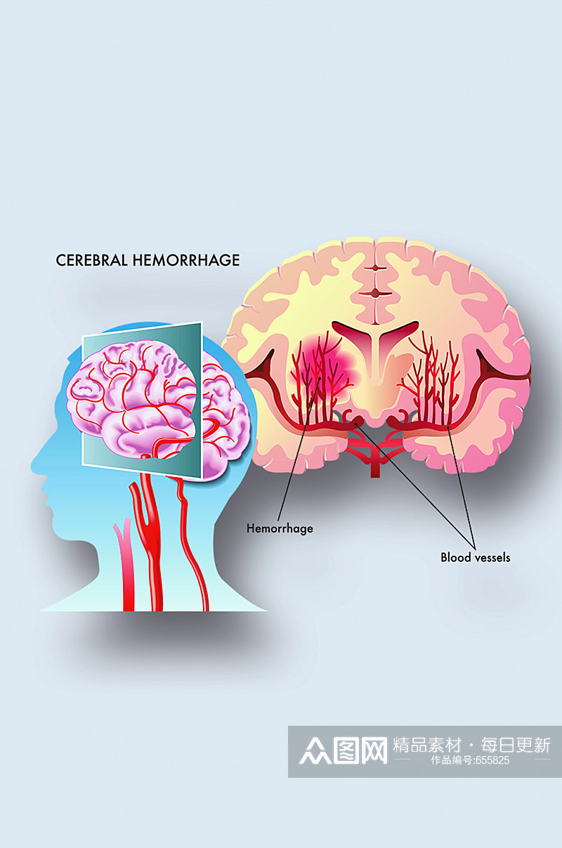 脑出血病症解析图医学器官解剖插图素材