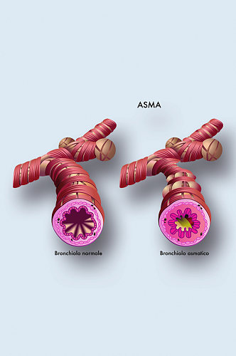 哮喘病症解析图医学器官解剖插图
