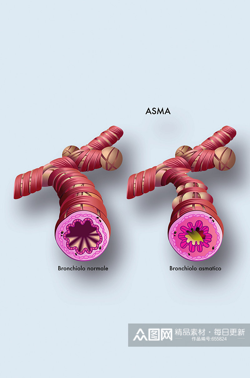 哮喘病症解析图医学器官解剖插图素材