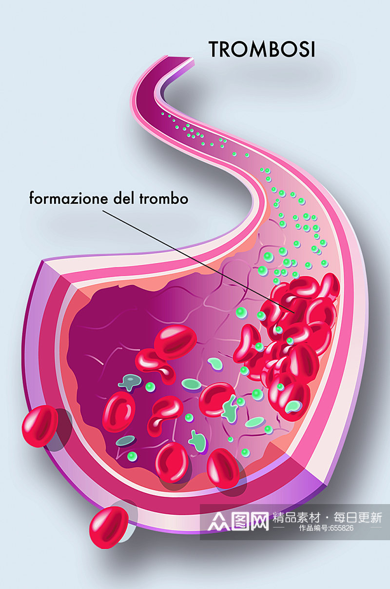 血管病症解析图医学器官解剖插图素材