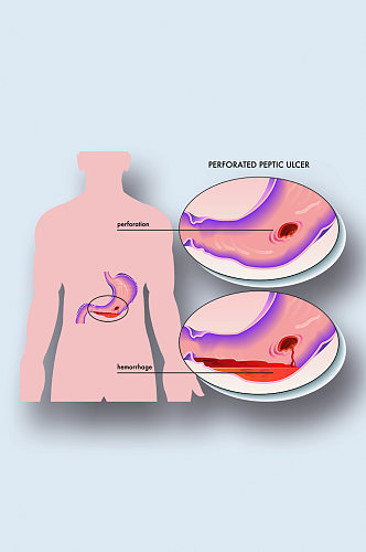 消化性胃溃疡病症解析图医学器官解剖插图