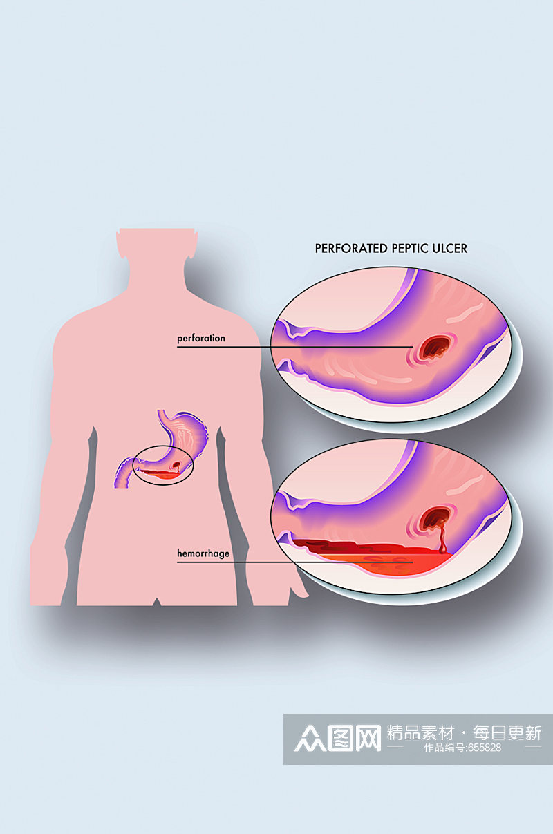 消化性胃溃疡病症解析图医学器官解剖插图素材