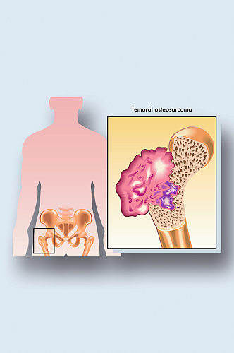 成骨肉瘤病症解析图医学器官解剖插图
