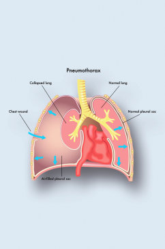 气胸病症解析图医学器官解剖插图