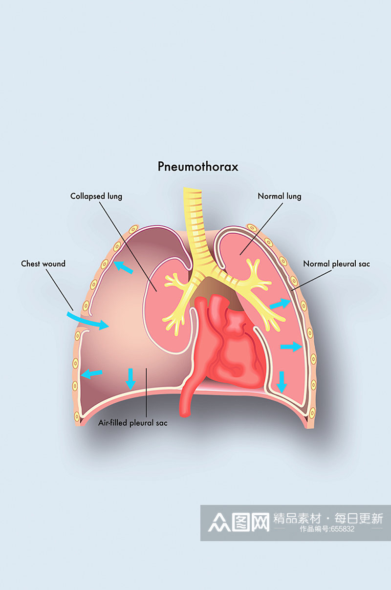 气胸病症解析图医学器官解剖插图素材