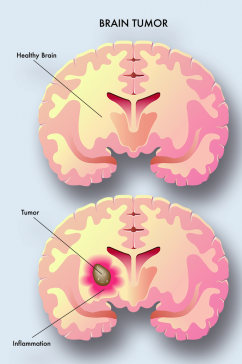 脑瘤病症解析图医学器官解剖插图