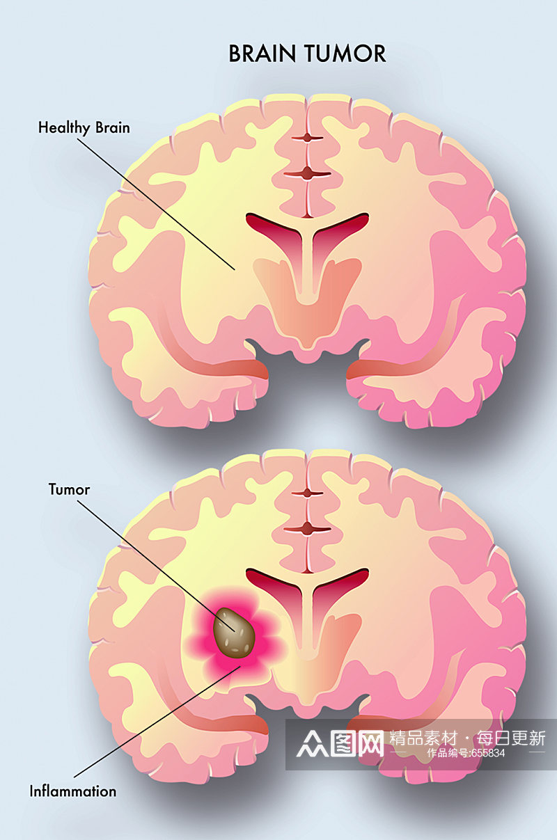 脑瘤病症解析图医学器官解剖插图素材