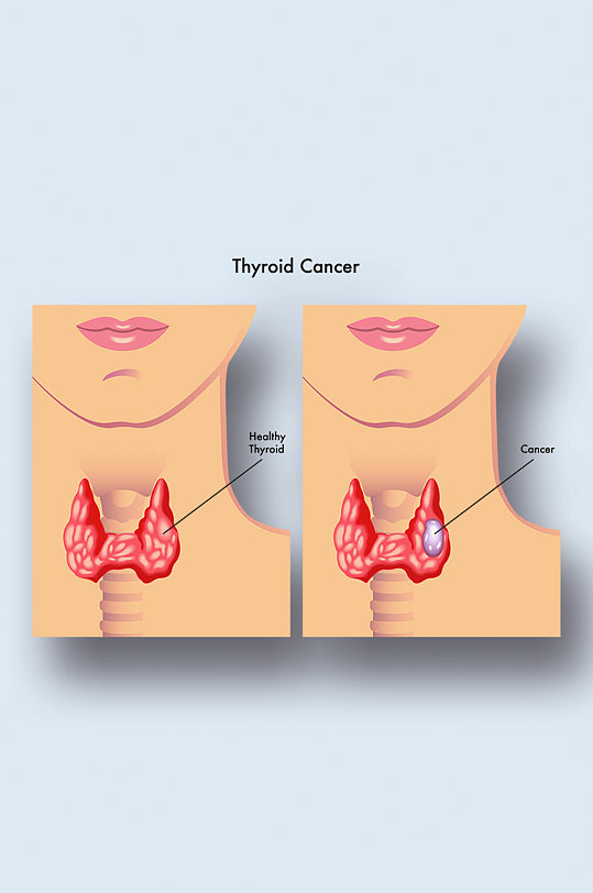 甲状腺癌医学人体器官组织解剖插图元素