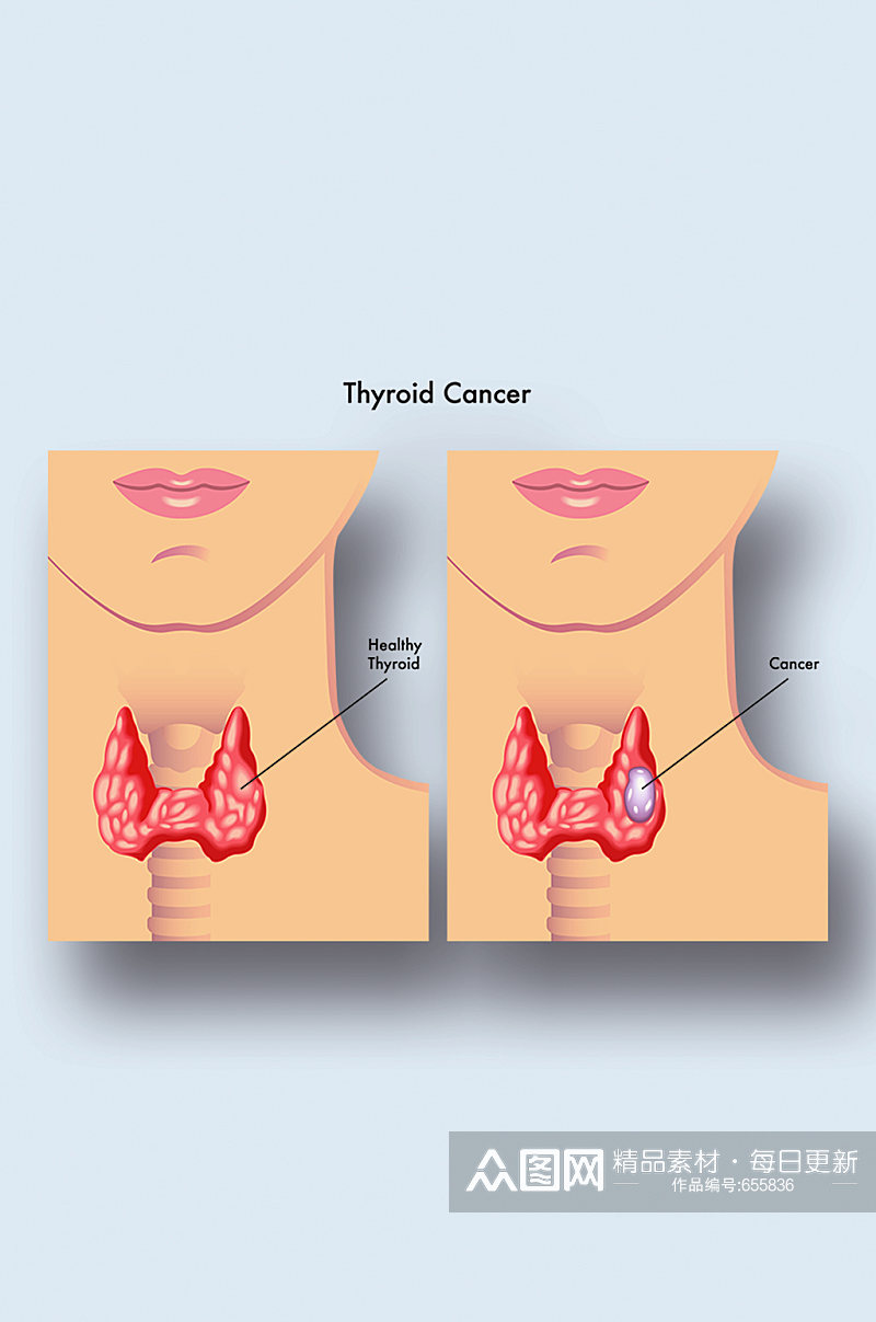 甲状腺癌医学人体器官组织解剖插图元素素材