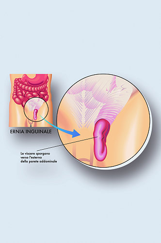腹股病症解析图医学器官解剖插图
