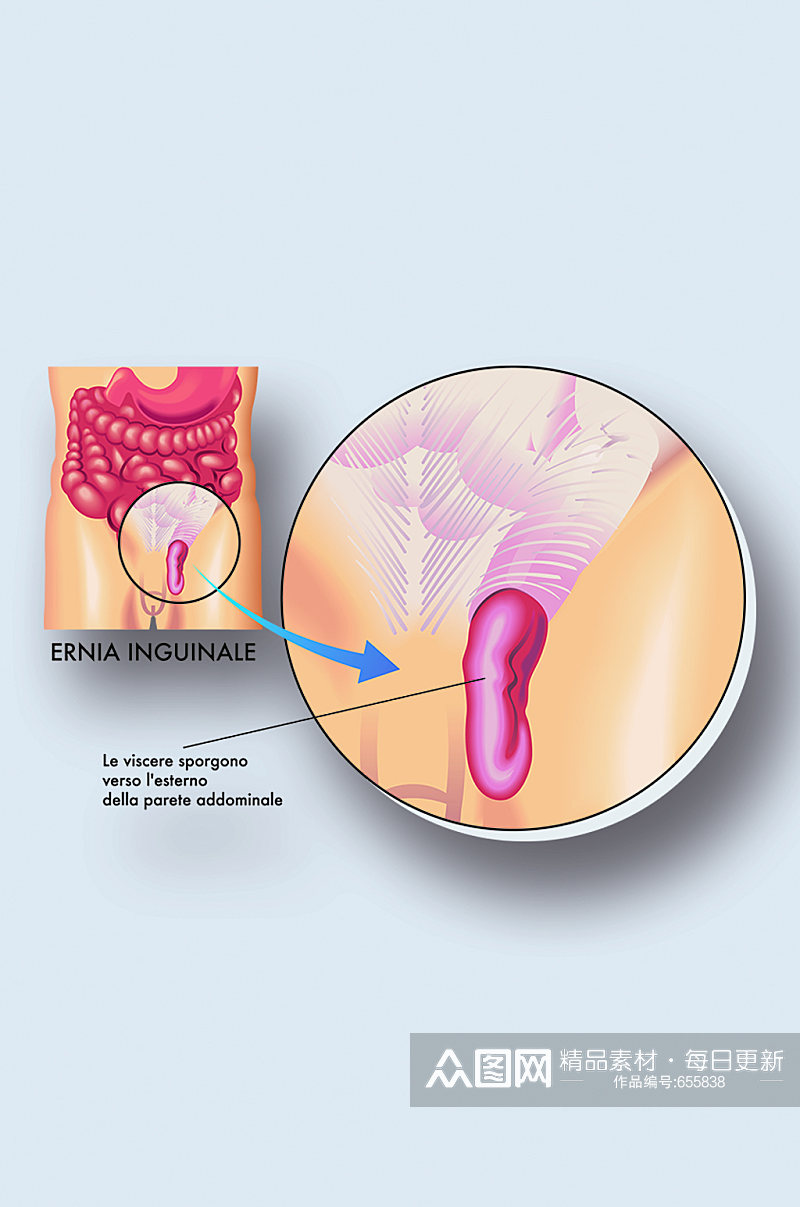 腹股病症解析图医学器官解剖插图素材