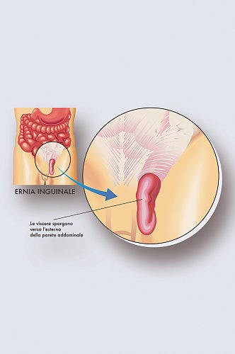 腹股病症解析图医学器官解剖插图