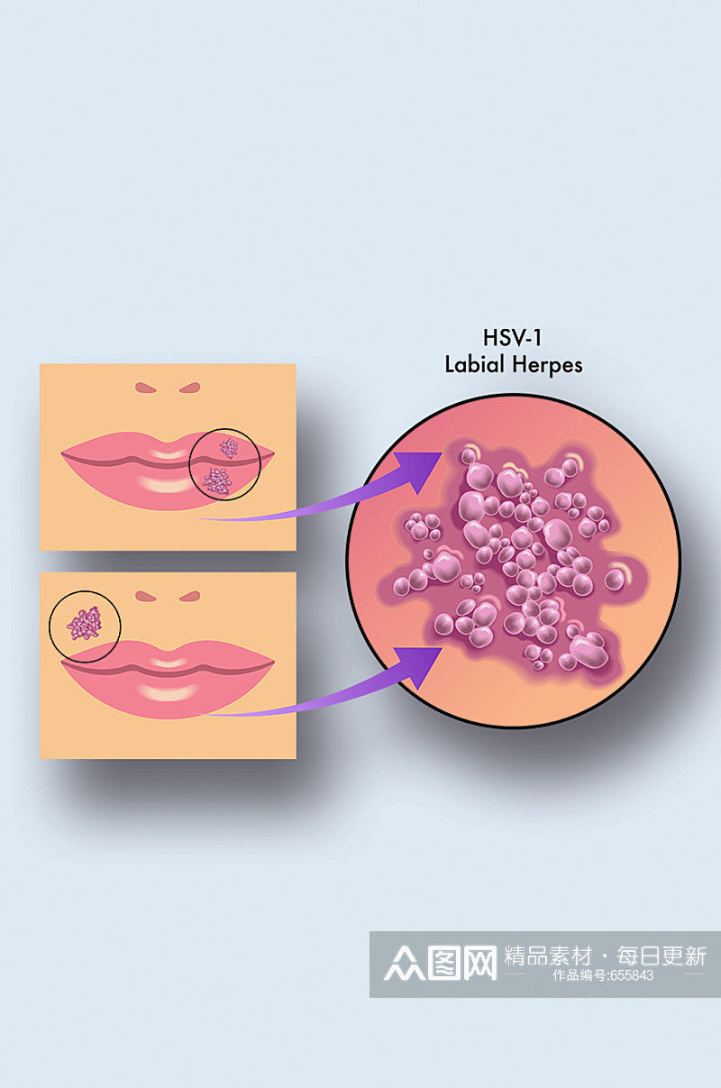 唇疱疹病症解析图医学器官解剖插图素材