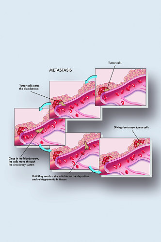 癌细胞病症解析图医学器官解剖插图
