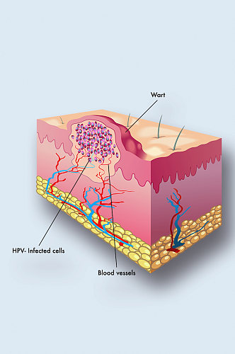 疣皮肤病病症解析图医学器官解剖插图