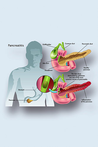 胰腺炎病症解析图医学器官解剖插图
