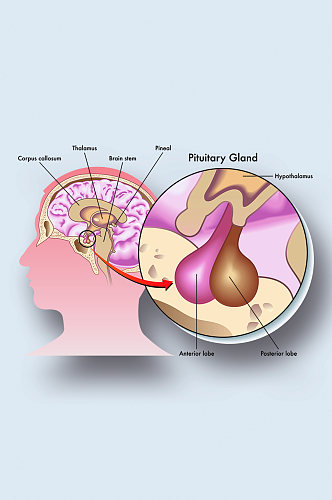 脑垂体病症解析图医学器官解剖插图