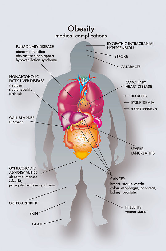 肥胖症病症解析图医学器官解剖插图