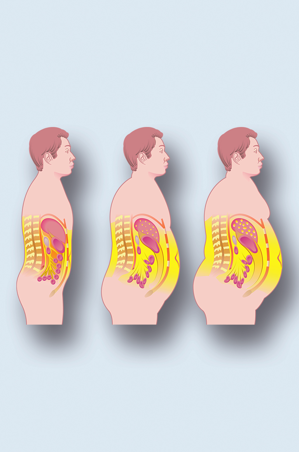 肥胖症病症解析图医学器官解剖插图