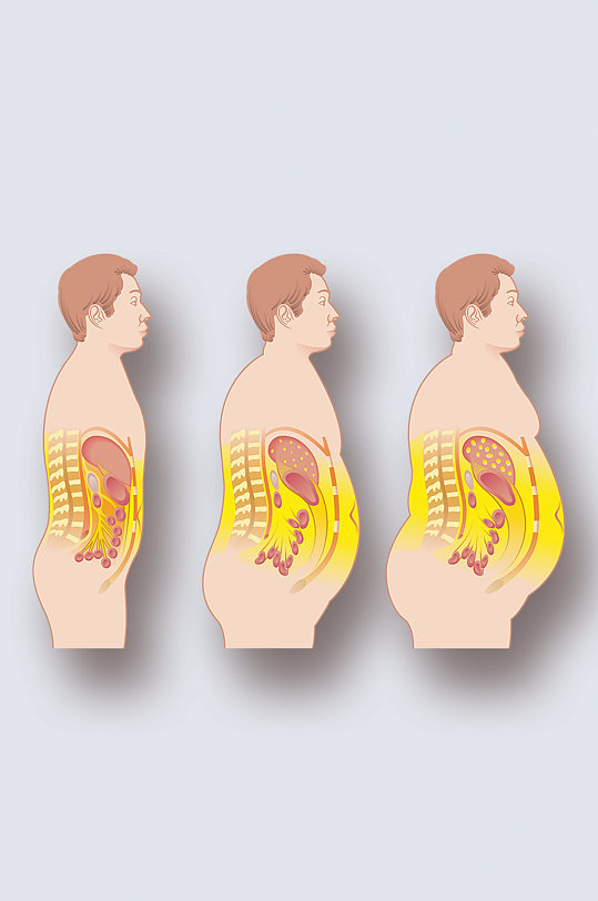 肥胖症病症解析图医学器官解剖插图