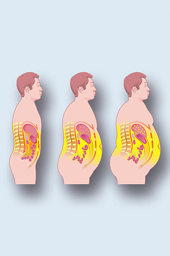 肥胖症病症解析图医学器官解剖插图