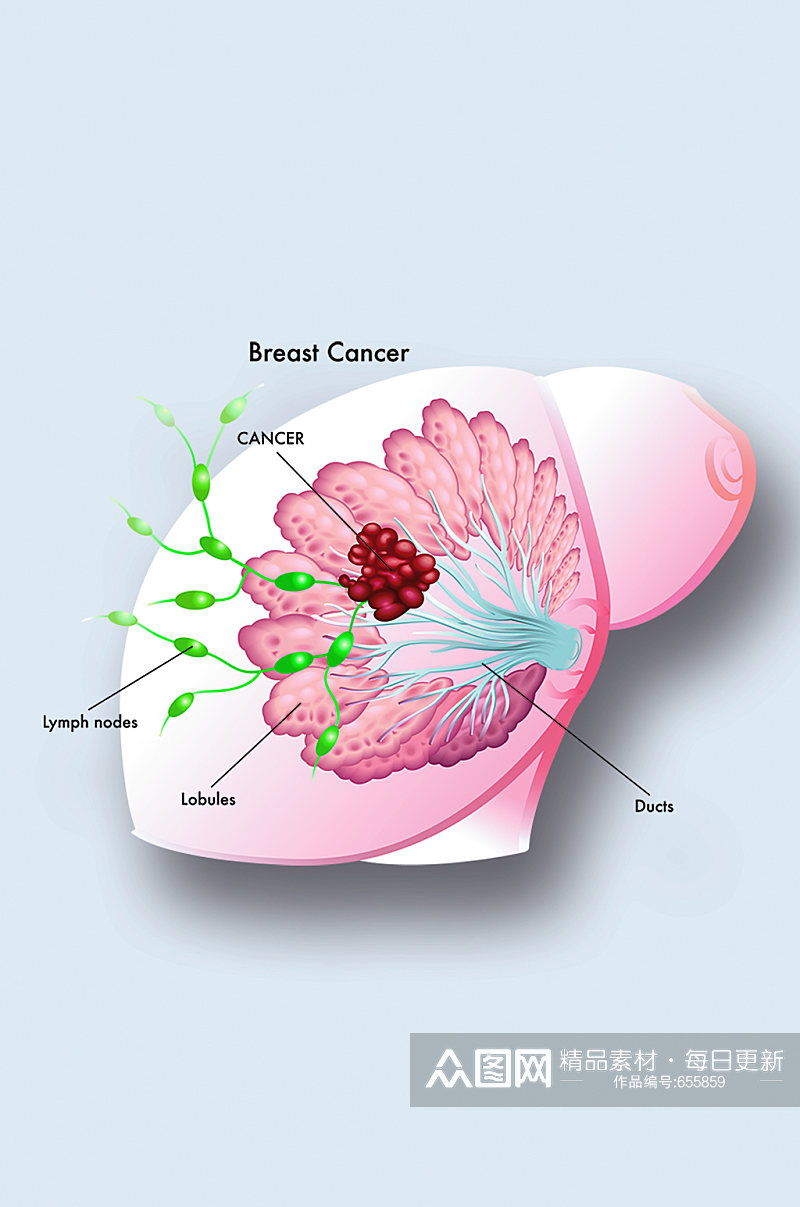 乳癌病症解析图医学器官解剖插图素材