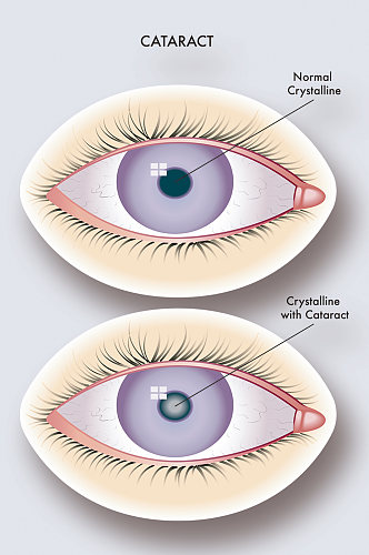白内障病症解析图医学器官解剖插图