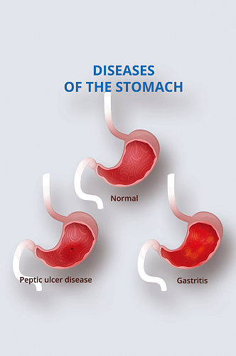 胃病医学人体器官组织解剖插图元素