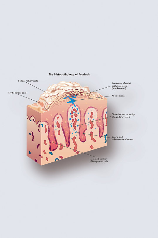 银屑病病症解析图医学器官解剖插图